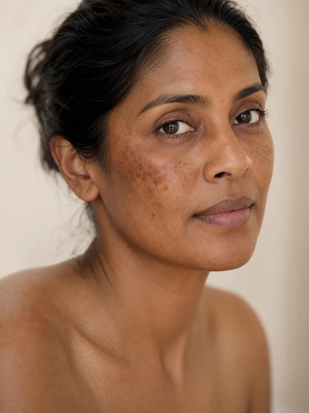 Pigmentation Treatments