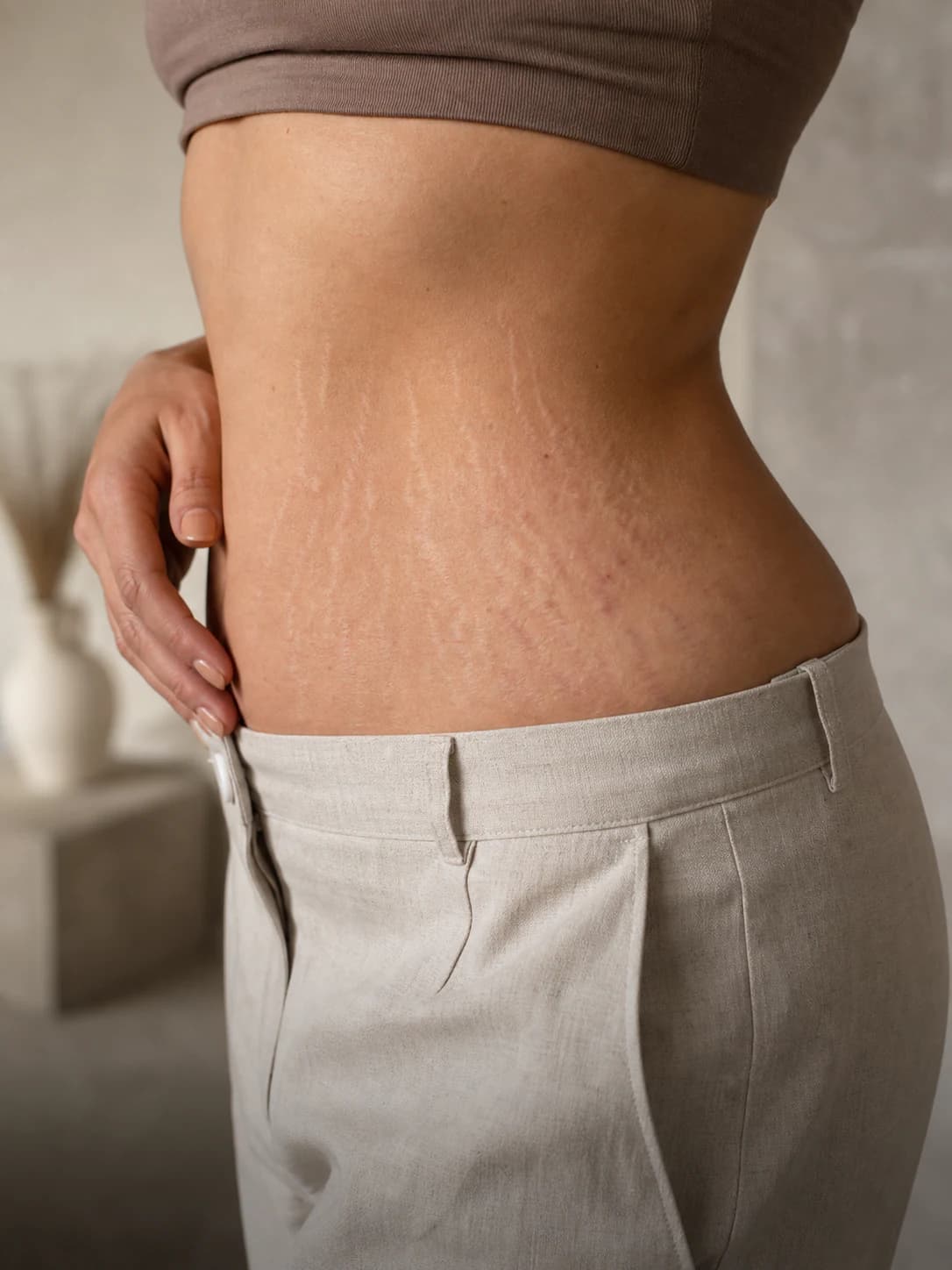 Stretch Marks