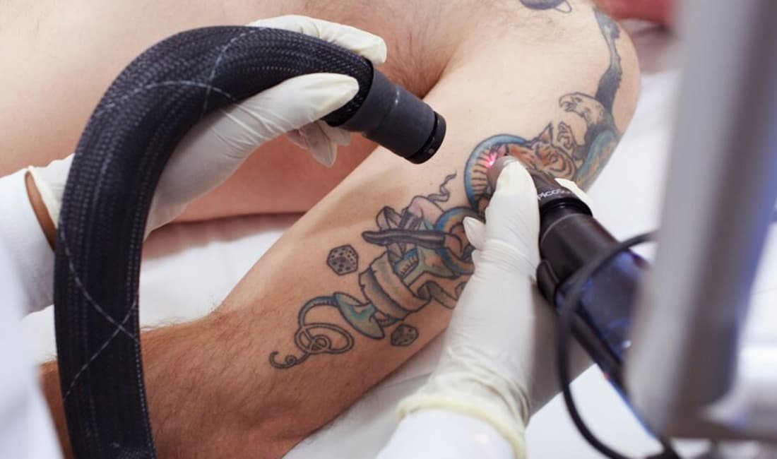 Tattoo Removal equipment