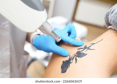 How Tattoo removal works: understanding the process and aftercare