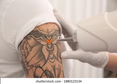 How Tattoo removal works: understanding the process and aftercare