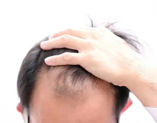 hair_loss