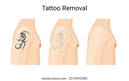 How Tattoo removal works: understanding the process and aftercare