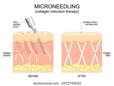 Micro-needling for skin: Overview of the treatment and benefits