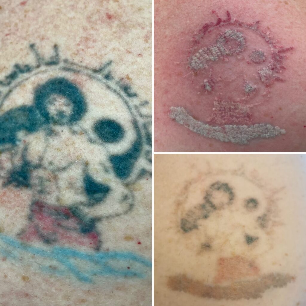 laser tattoo removal Ottawa