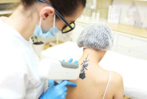 laser tattoo removal Ottawa tips