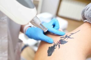 Best Tattoo Removal Ottawa