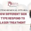 tattoo removal ottawa