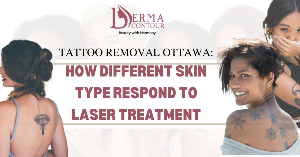 tattoo removal ottawa